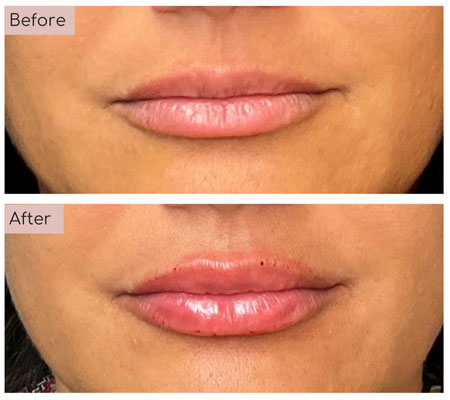 lip fillers before and afters